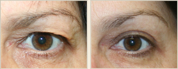 charlotte north carolina Blepharoplasty