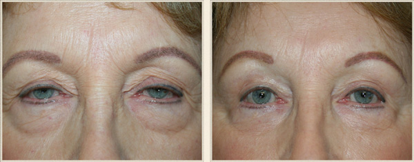 eyelid surgery north carolina