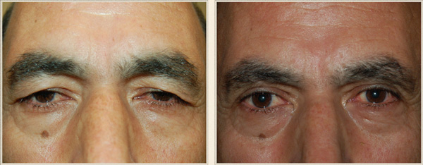 eyelid surgery charlotte north carolina