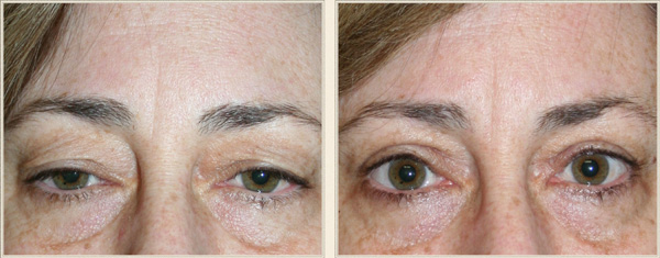 eyelid surgery north carolina