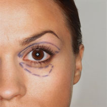 Charlotte North Carolina Eyelid Surgery