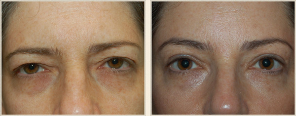 eyelid surgery charlotte north carolina