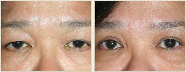 Blepharoplasty north carolina