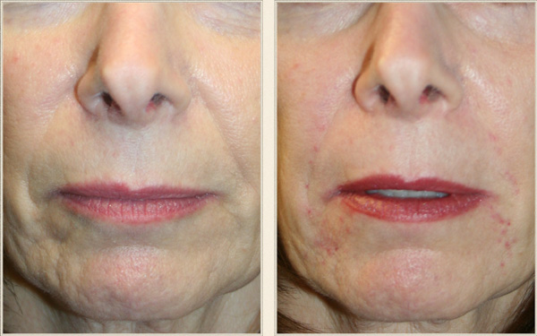 facial filler charlotte north carolina