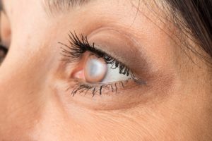 Qualities to look for in a cataract surgeon