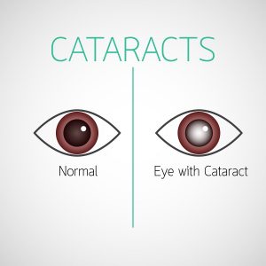 Cataract Myths