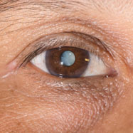 Cataract Treatment in North Carolina